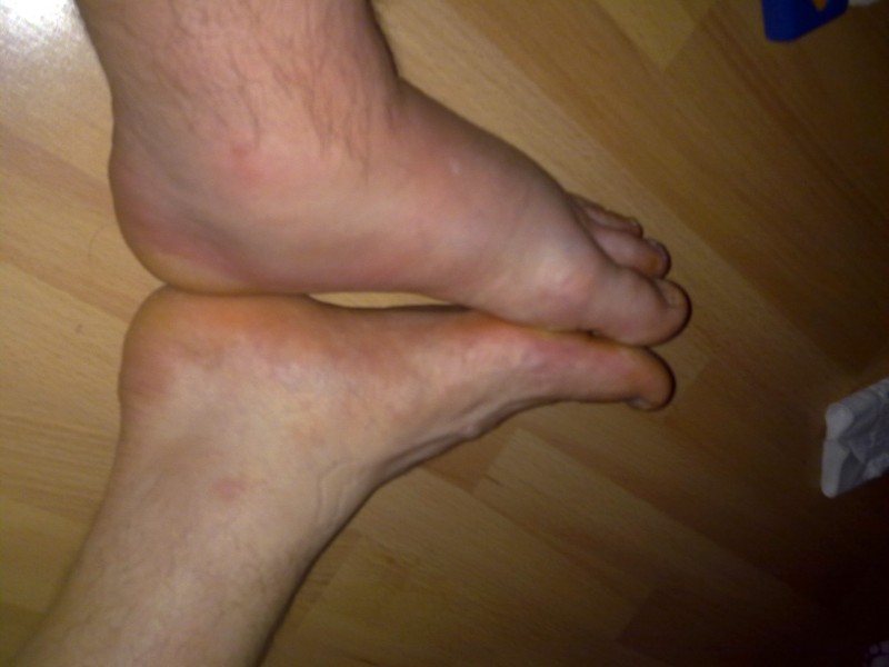 Jalan turvotus muutama päivä kisan jälkeen