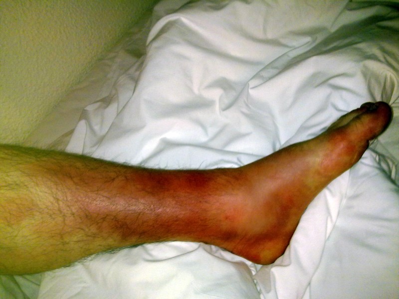 Jalka kisan jälkeisenä päivänä